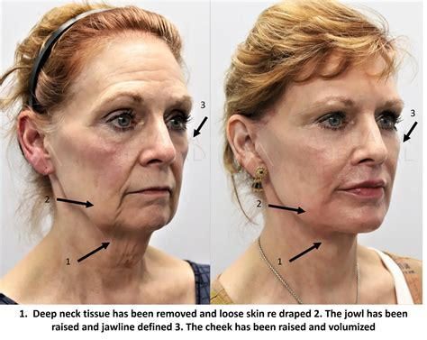 Facelift Montgomery | Lower Face & Neck Lift | Alabama Surgical Arts