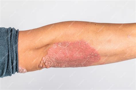 Uomo con mani malate pelle secca e squamosa sulla sua mano con psoriasi volgare eczema e altre ...