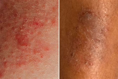 Eczema: Types, Symptoms, Causes, Diagnosis, and Treatment