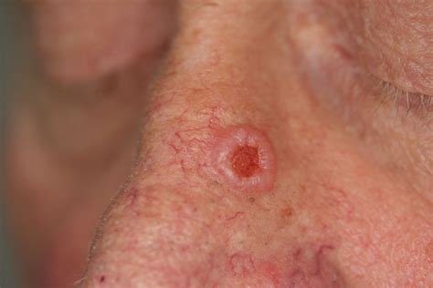 Nodular Basal Cell Carcinoma - DocCheck