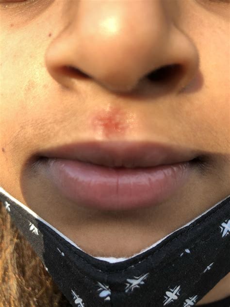 [Skin Concern] Scab/Rash on Upper Lip : r/SkincareAddiction