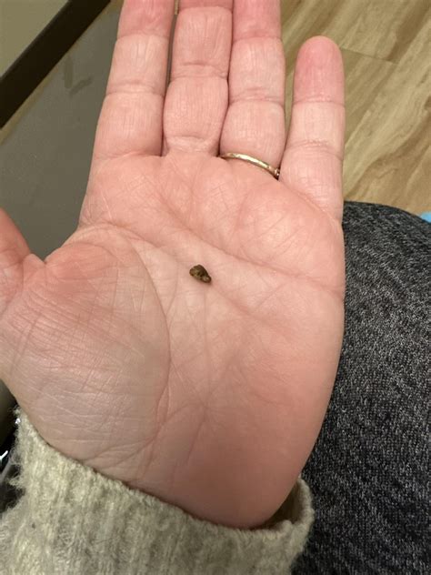 7mm kidney stone hell : r/KidneyStones