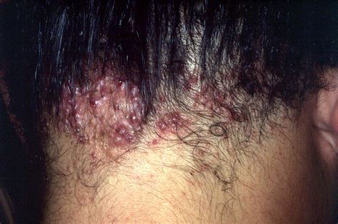 Pimples On Scalp