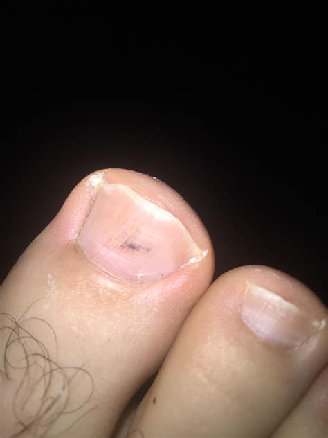 What Causes Black Spots On Nails at Donald Weekes blog