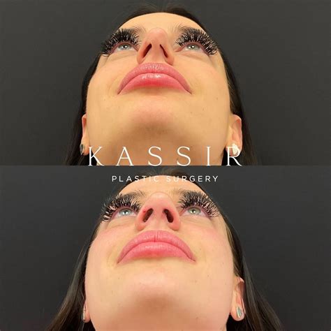 Nasal Septum Septoplasty: What To Expect From Nasal Septum Surgery