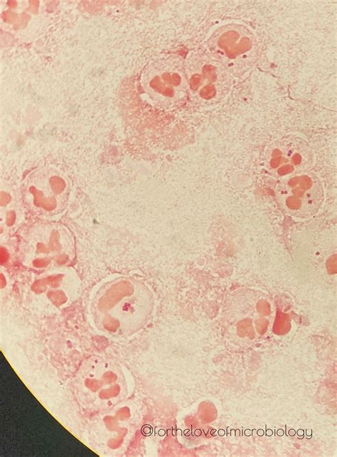 Gram Negative Diplococci In Sputum