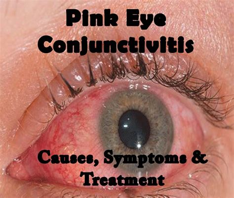 What Is The Difference Between Viral And Bacterial Pink Eye? – YLEAV