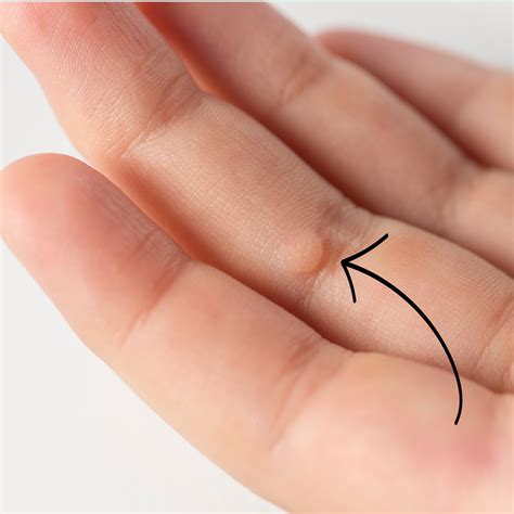 Skin Tags vs Cysts vs Warts: Identification Guide