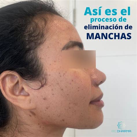 ¿ Qué es Melasma? - Clínica Estética en Medellín