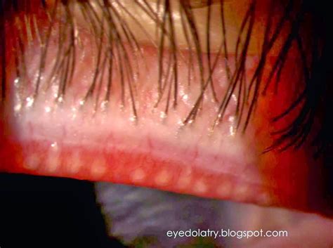 Meibomian Gland Expression