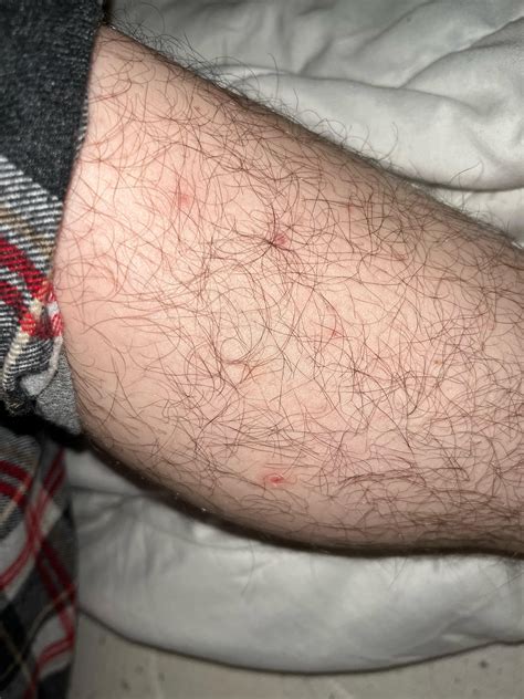 A few pimples like this randomly appears on my legs, thighs and ...