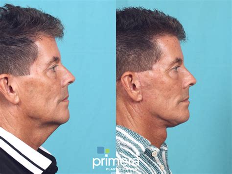 Neck Lift Before and After Pictures Case 842 | Orlando, Winter Park ...