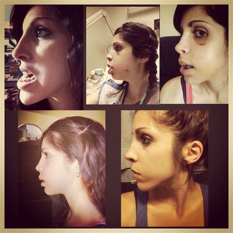 What Is Double Jaw Surgery - wehrpflicht deutschland