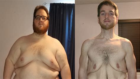 Fundraiser by Steven Strickland : Steven's Excess Skin Removal Surgery