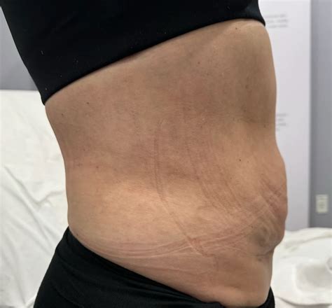 Liposuction Before & After In Hoboken And Weehawken, NJ