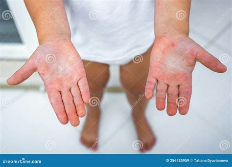 Enterovirus Leg - Arm - Mouth. Rash on the Body of a Child. Cocksackie ...