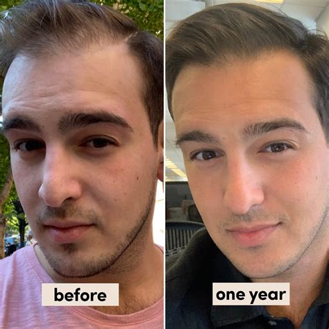 eDrugStore Expert Reviews Hims Hair Loss & Regrowth Treatment