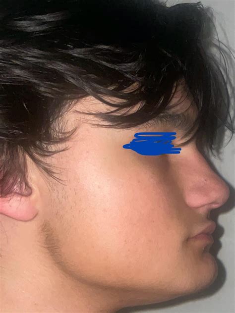 Short face syndrome? Im 16 and here are some photos with my teeth touching, my mom says its ...