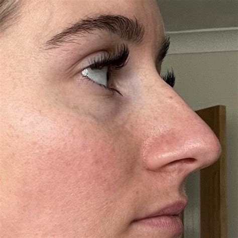 Septorhinoplasty | Deviated Septum | Pall Mall