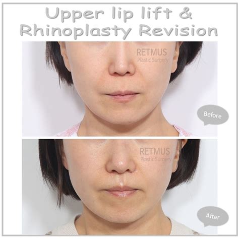 lip lift before and after - Retmus Plastic Surgery 리트머스성형외과 on Instagram: " Upper lip lift ...