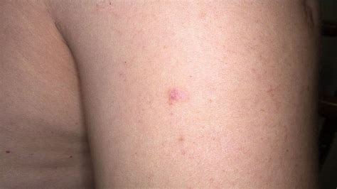 Superficial Basal Cell Carcinoma Early Stages