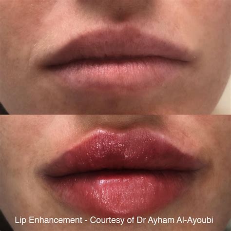 Fat Transfer To Lips Before And After | Lipstutorial.org