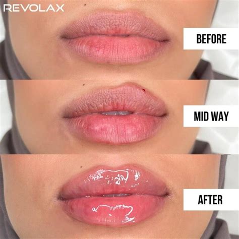 Lip Filler Before and After Photos and Results - the daily glimmer