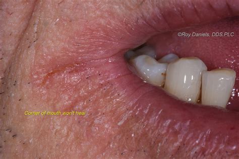 Angular Cheilitis Is the Gross Mouth Infection You Didn't Know You've ...