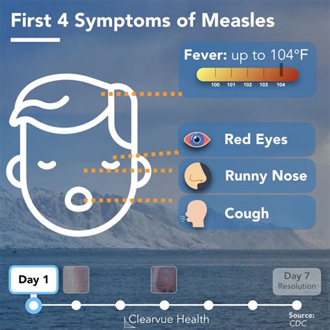 Recognizing Measles: Key Symptoms and Features