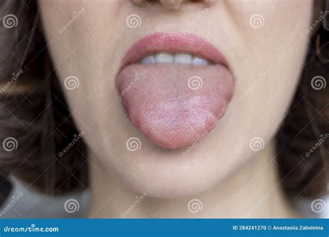 Angioedema Tongue