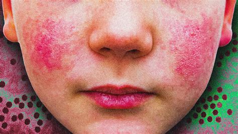 CDC Alerts U.S. About Surge in Parvovirus B19 Cases: What You Need to ...