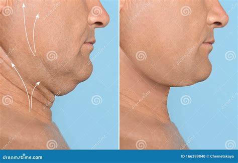 Mature Man before and after Surgery Operation on Blue Background, Closeup. Double Chin Problem ...