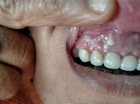 Gum infection with cyst and bone loss than bone graft failure : r/PeriodontalDisease