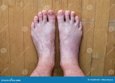 Swollen Left Foot Comparison After Wasp Sting On Female Foot Royalty ...
