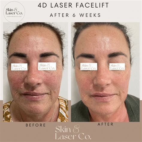 Fotona 4D Non- Surgical Facelift - Skin Laser Co
