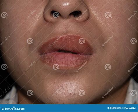 Swollen or Thickened Upper Lip of Asian Man. Angioedema. Causes May Be ...