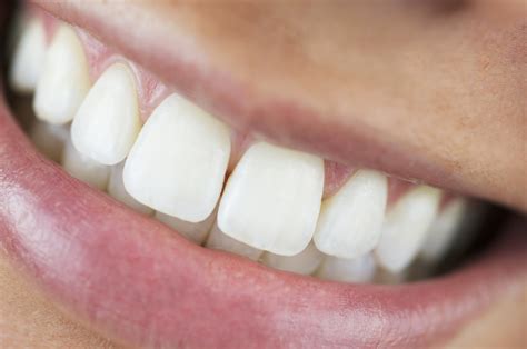 Overbite Overbite Correction Options