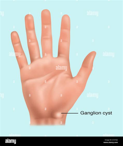 Wrist Immobilizer For Ganglion Cyst at Benjamin Mott blog