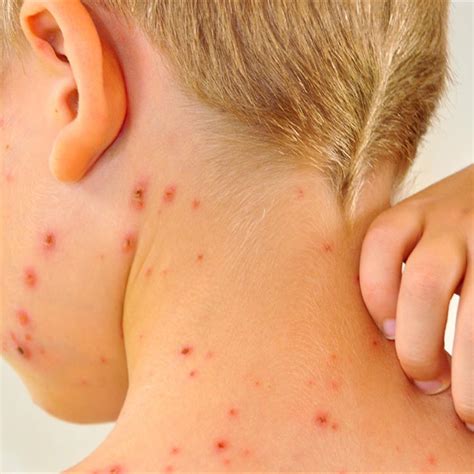 List 97+ Pictures Chicken Pox Photos Early Stages Updated