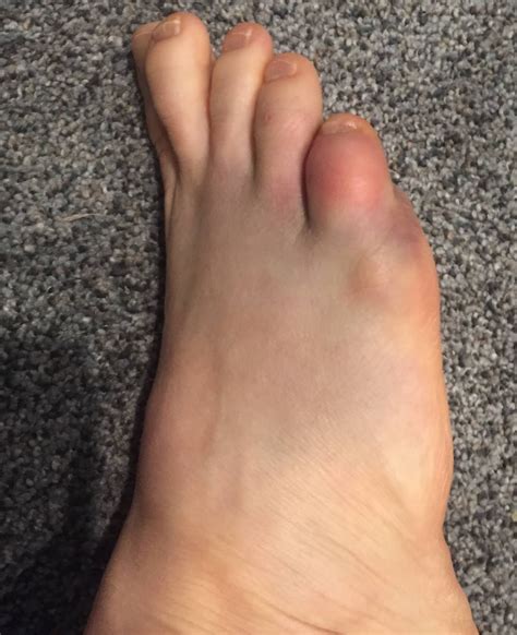 Top 95+ Pictures Bruise On Side Of Foot No Reason Completed