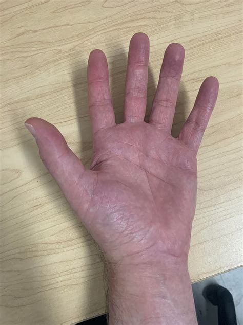 Simponi Aria - infusion side effects? : r/PsoriaticArthritis