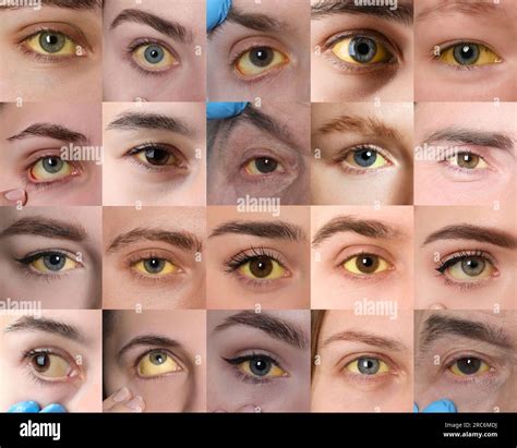Yellowing of eyes as symptom of hepatitis. Collage with photos of people Stock Photo - Alamy