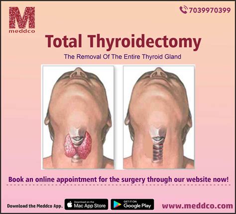 Thyroidectomy Frontiers | Comparison Of Supraclavicular Oblique
