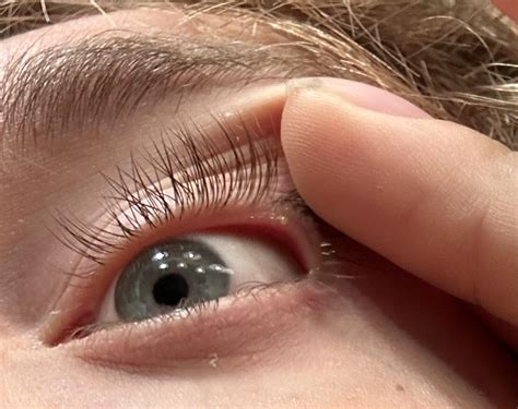 White Bump On Eyelid