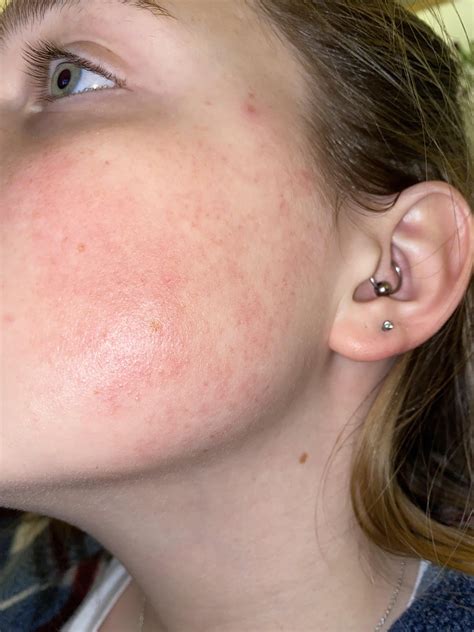 Looking for advice about the little red bumps on my face (they’re also on my arms and legs too ...