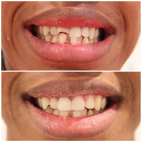 Broken Teeth Before And After
