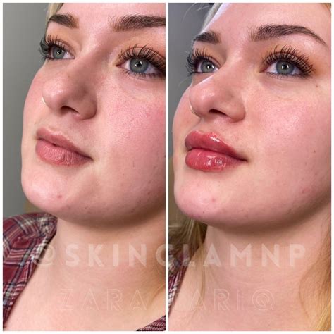 Lip touch up for my beautiful client 💕 * * * * * botox before and after botox brow lift botox ...