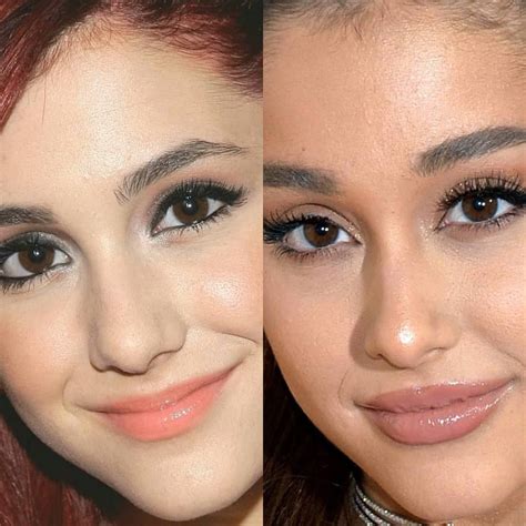 Best of Plastic Surgery on Instagram: “🎙Thank you, next? 💉 . What has ...