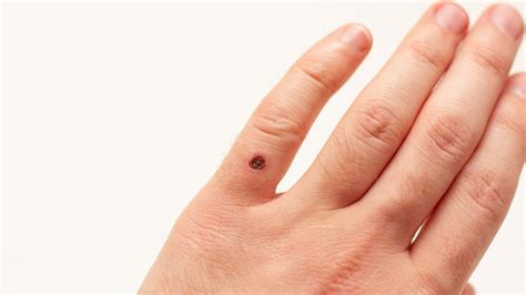 Eliminación de Mezquinos en Guadalajara | Dr. Nicolás Hernández