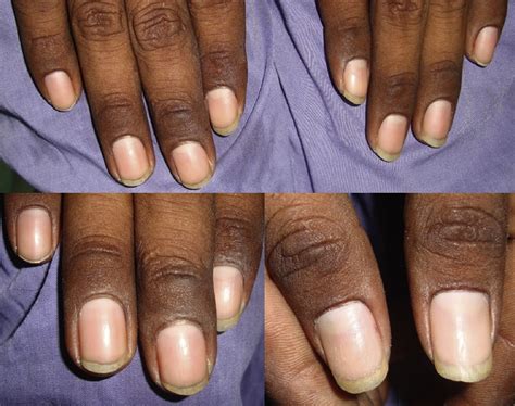 Diagnosis Using the Proximal and Lateral Nail Folds - Dermatologic Clinics